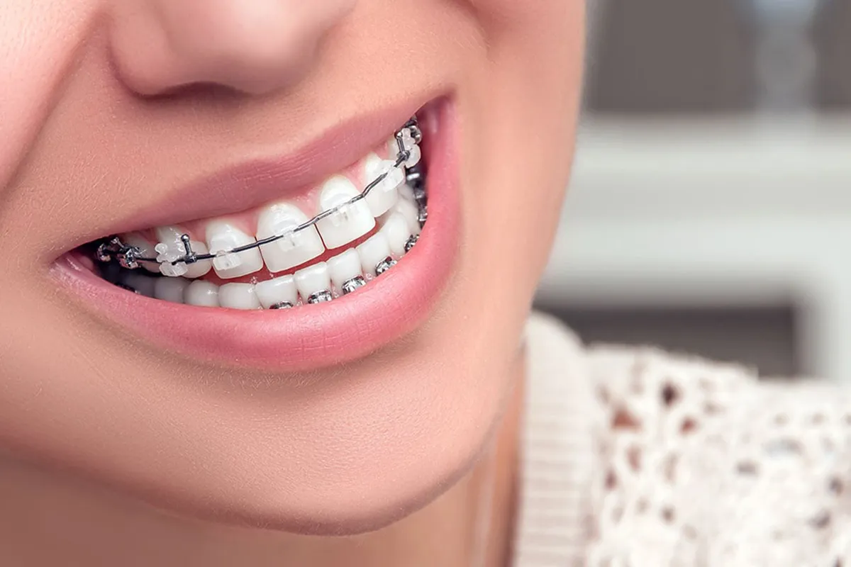 What is the Best Age for Braces?